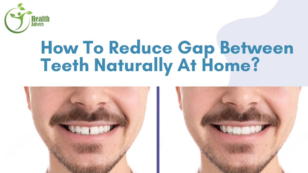 How to Reduce Gap Between Teeth Naturally at Home?