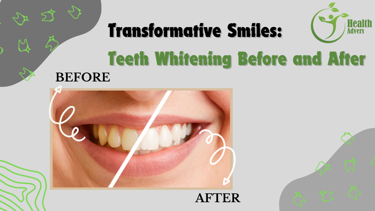 Transformative Smiles: Teeth Whitening Before and After